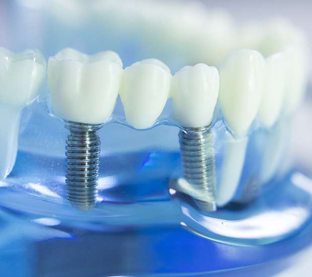 Elizabeth Dental Implants