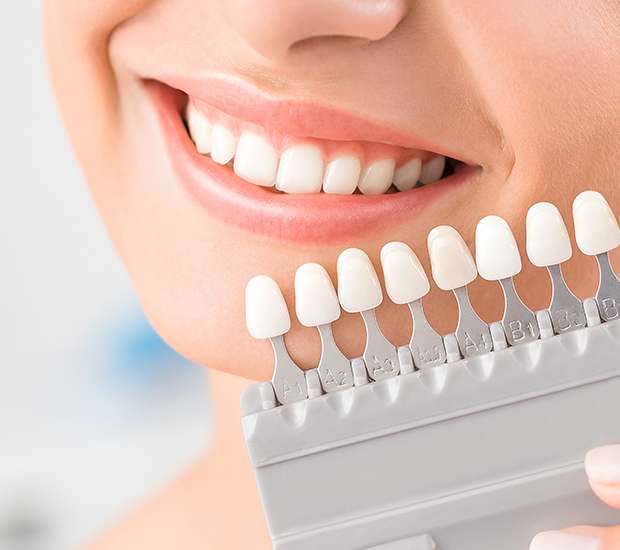 Elizabeth Dental Veneers and Dental Laminates